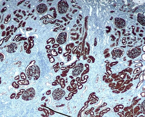 Anticuerpo Monoclonal CD20